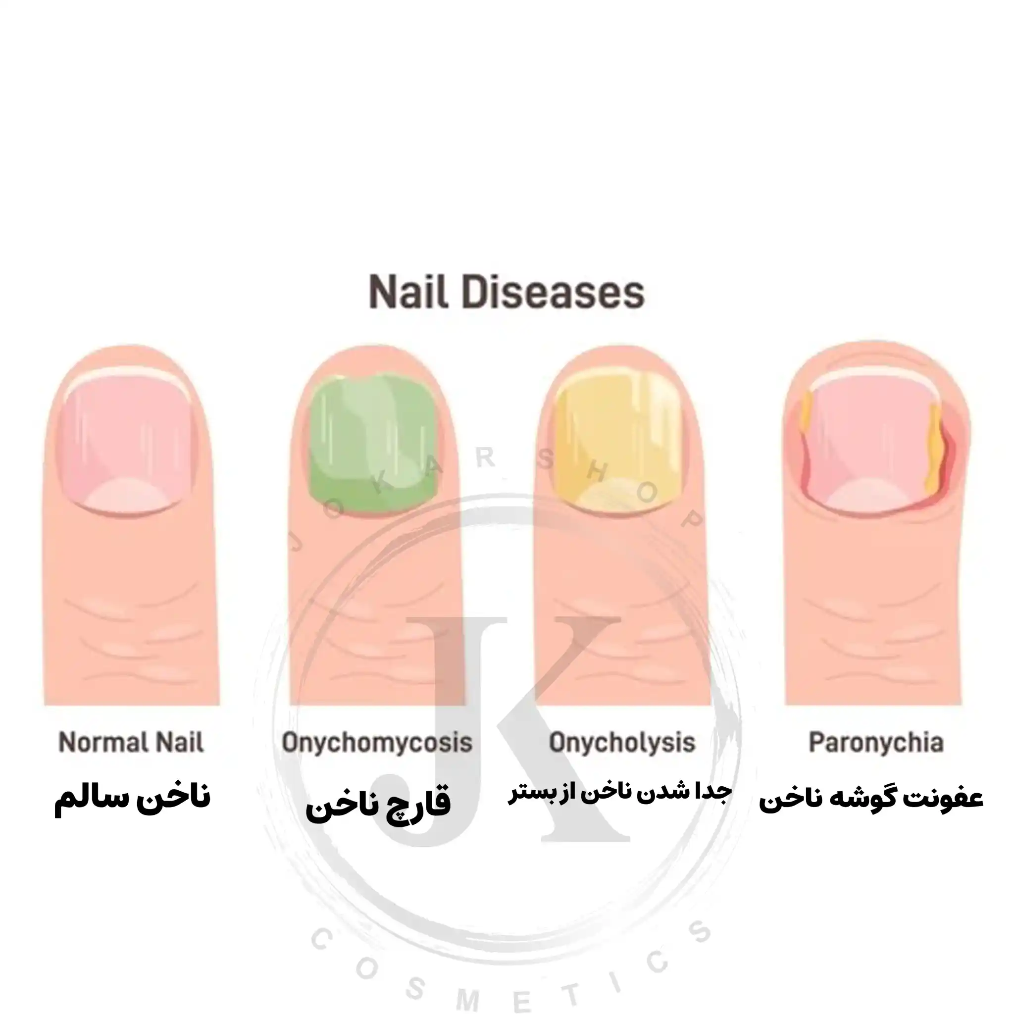قارچ-ناخن-کاشت-ناخن-فروشگاه-جوکار