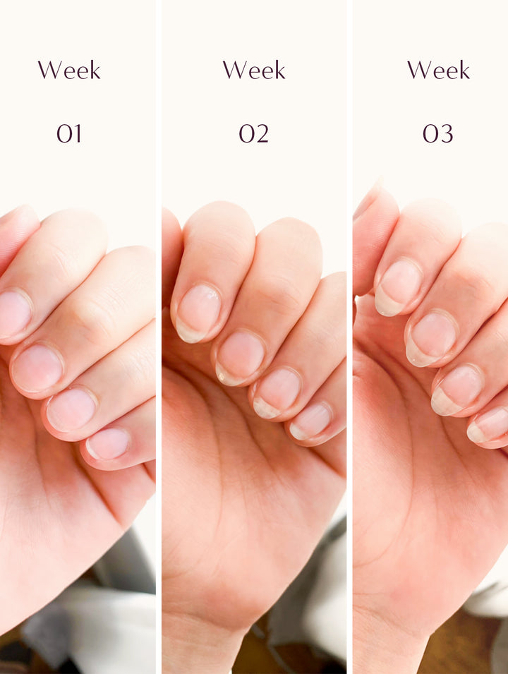 درمان فوری ناخن اسیب دیده